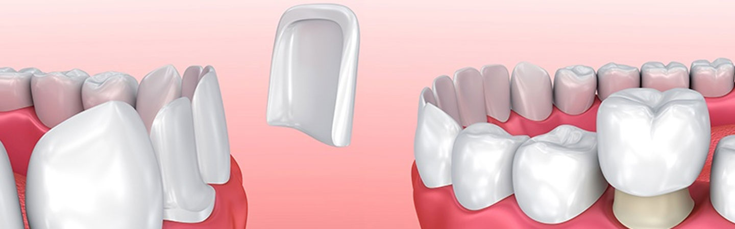 Crowns and Veneers Dental Restorative Materials