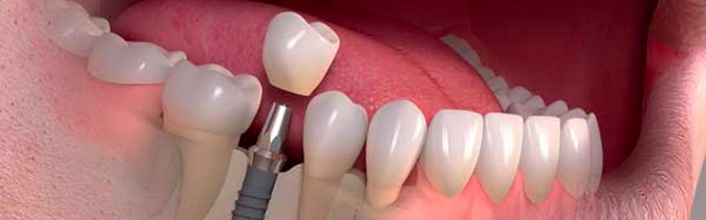 immediate implants dental cosmetic turkey